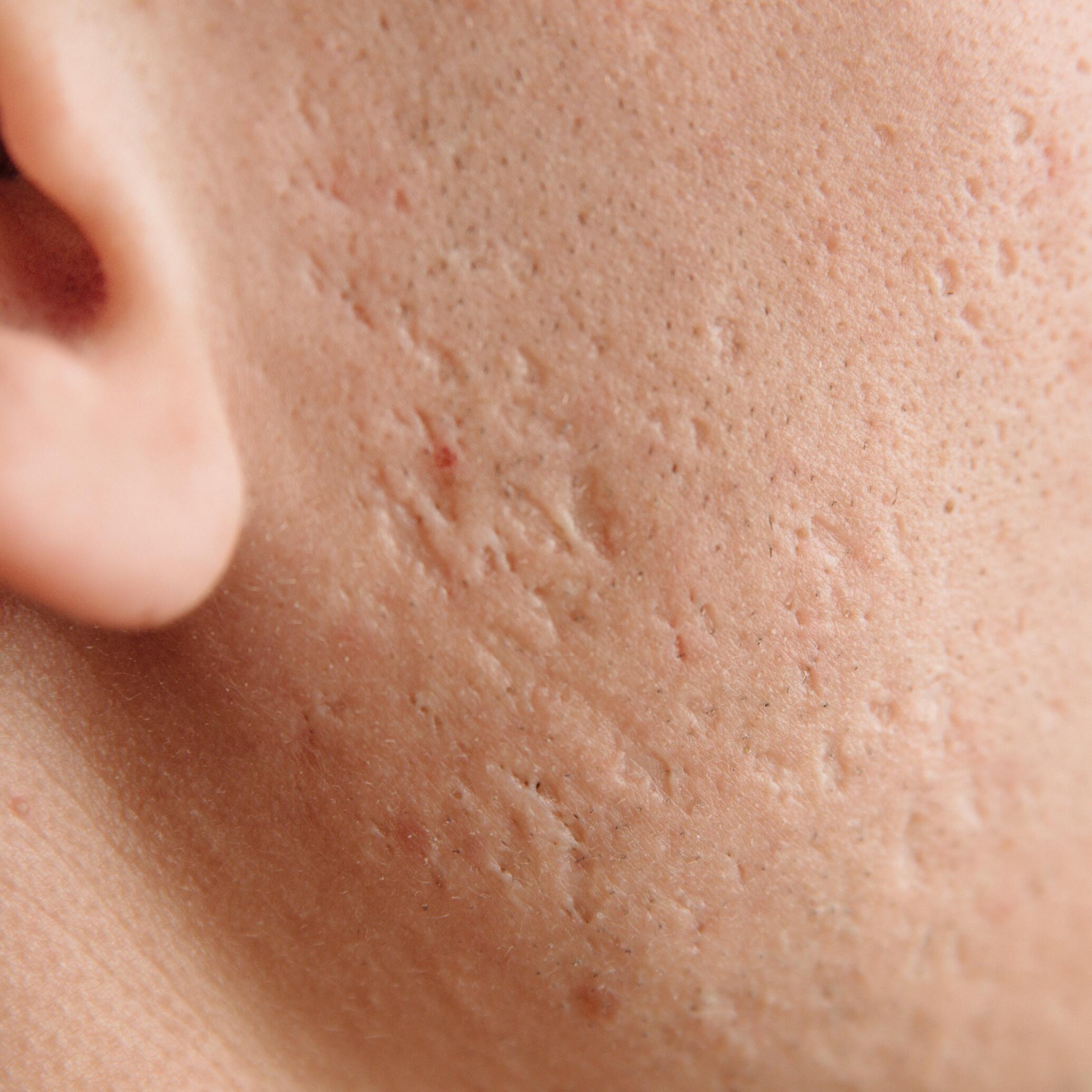 cicatrice atrofica sul viso